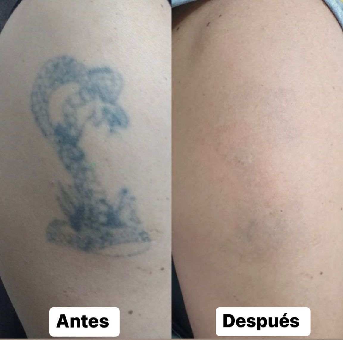 Remoción de tatuajes / micropigmentación con láser – LA CROIX URUGUAY